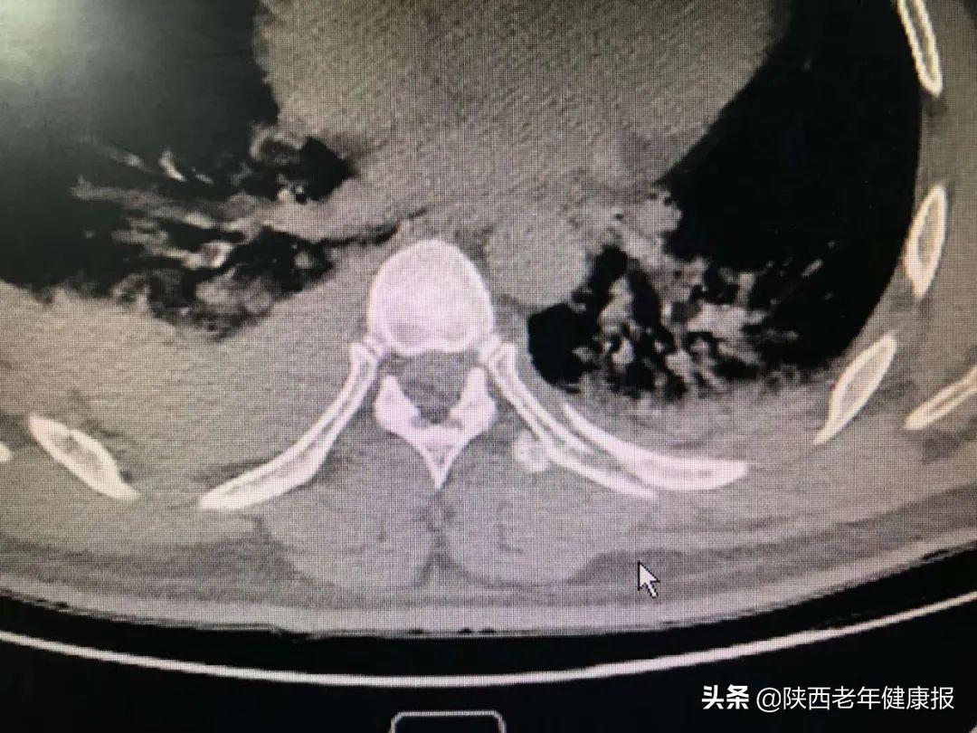 关于九个月大的宝宝肋骨高的观察与理解